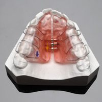hoofd walgelijk gesloten Beugel – Orthodontiepraktijk Nieuwegein