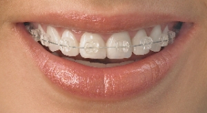 Whitney Regelmatigheid Clan Onzichtbare beugels – Orthodontiepraktijk Nieuwegein